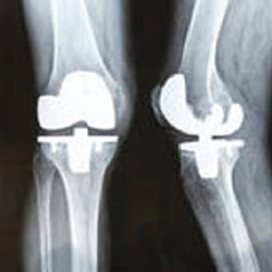 x-ray of legs